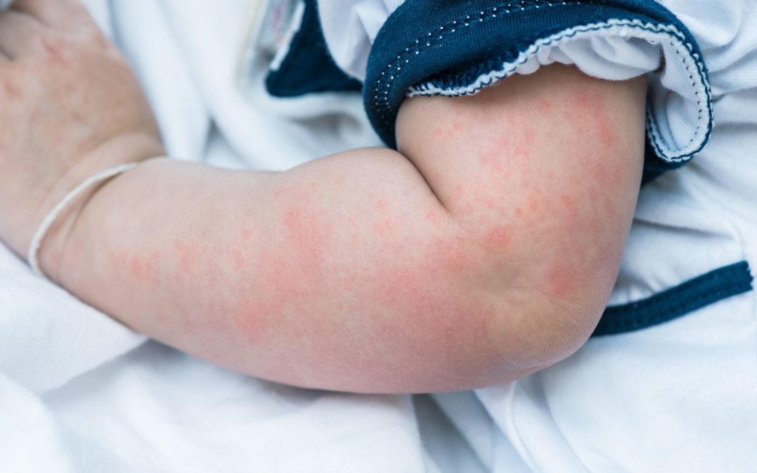 Allergien – Darmsymptome – Anzeichen schnell erkennen
