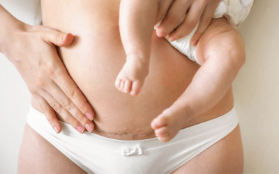 Kaiserschnittnarbe: So wird sie gepflegt