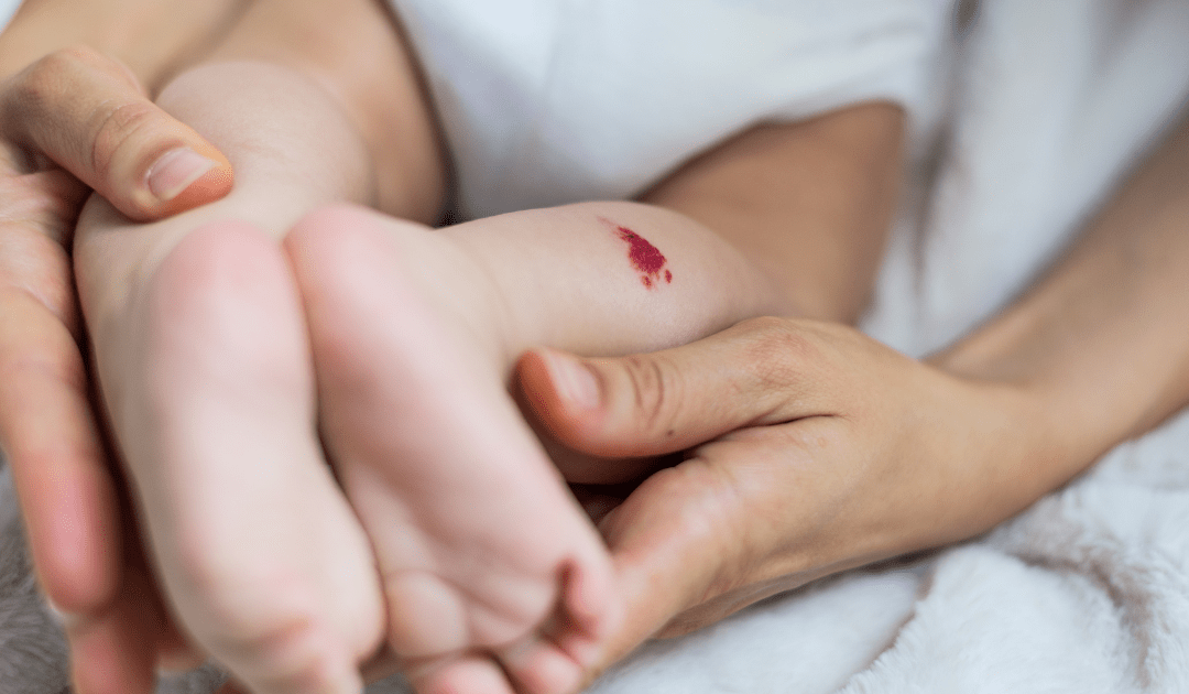 Infantile Hämangiome: Blutschwämmchen beim Kind